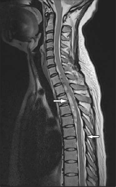 Mri Scan Shows Anterior Subdural Hematoma Arrows With Spinal Cord The