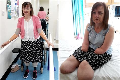 carer collapses at work and wakes up with both arms and legs amputated metro news