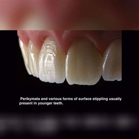 7 Tips For Highly Effective Composite Restorations One Dental Is The