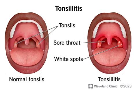 Ways To Diagnose Tonsillitis The Tech Edvocate