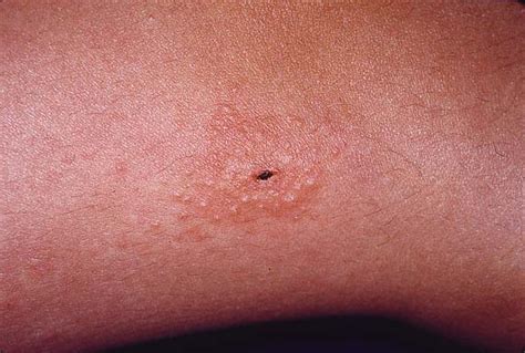 Black Spot Poison Ivy A Report Of 5 Cases And A Review Of The