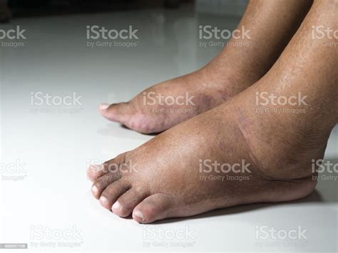 Swollen Legs And Feet Diabetes