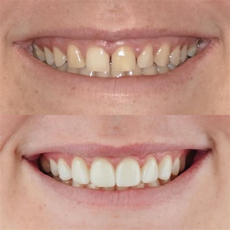 Enhance Your Smile With Dental Veneers