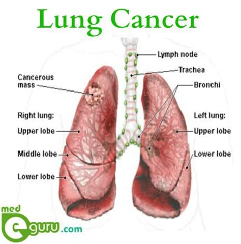 Usually, wheezing occurs when the airways in the lungs become blocked or inflamed. Lung Cancer Overview | Lung Cancer Symptoms - MedeguruMed ...
