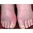 Edema Swelling Of Feet  Stock Image C027/1081 Science Photo Library
