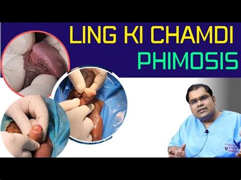 Phimosis 10 Examples What Is Phimosis YouTube