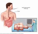 Gerd Symptoms Mayo Clinic Pictures