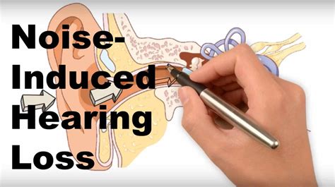 Noise Induced Hearing Loss Pacific Northwest Audiology