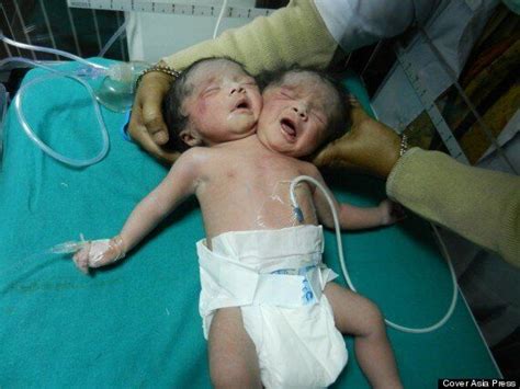 Very Very Rare Conjoined Twins Born In India Pictures Huffpost Uk