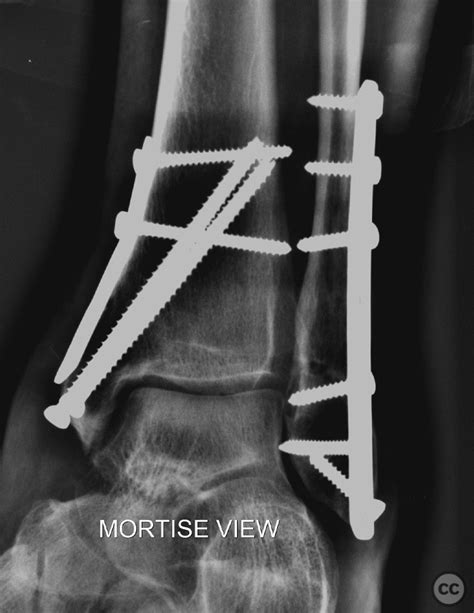 Compound Fracture Dislocation Of Left Ankle