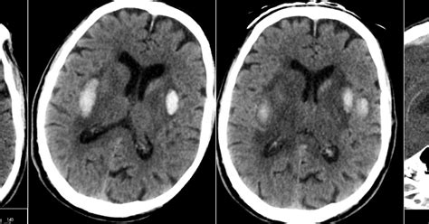 Deep Cerebral Venous Sinus Thrombosis With External