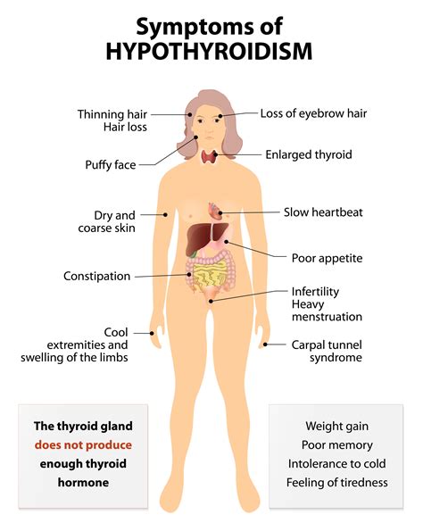 Cum Se Manifest Hipotiroidia La Adult Endocris Center