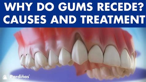 Gum Recession Treatment Of Gingival Retraction © Youtube