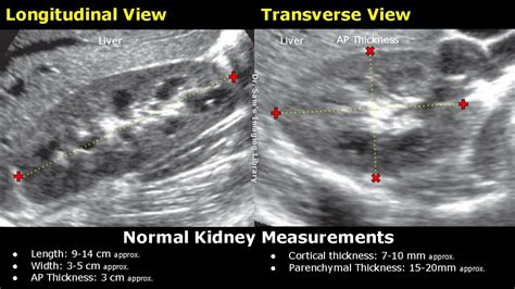 Normal Kidney Ultrasound