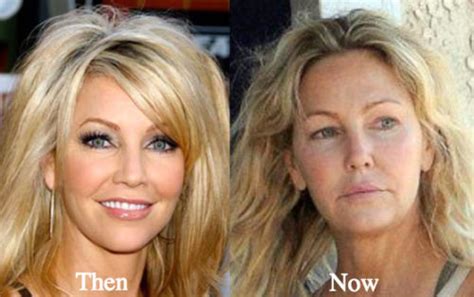 Heather Locklear Plastic Surgery Before And After Photos