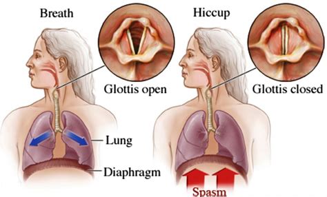 Hiccups Causes Symptoms Diagnosis And Best Treatment