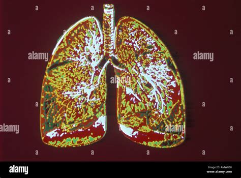 Angiografía Pulmonar Normal Fotografía De Stock Alamy
