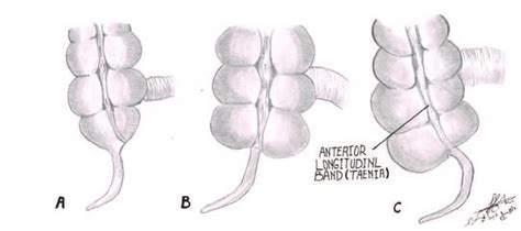 Types Of The Appendix And Cecum Aandb Represent Infantile Form When