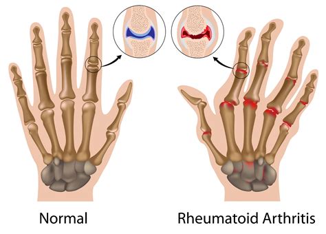 what is arthritis it could be gout rheumatoid arthritis or osteoarthritis university health