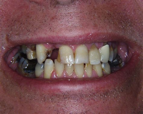 Lost Teeth Due To Decay And Gum Disease Teeth Pictures Gum Disease