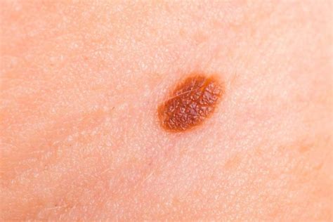 Is It Time For A Mole Removal Pcp For Life