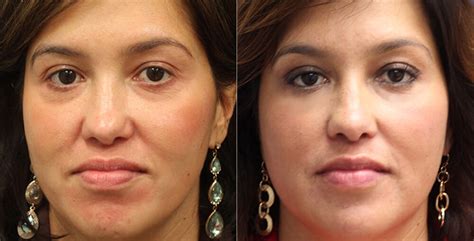 Facial Fat Transfer Los Angeles Non Surgical Facelift Beverly Hills