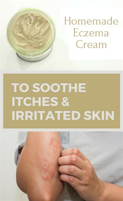 Homemade Eczema Cream To Soothe Itches And Irritated Skin Eczema Cream