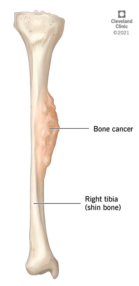 Top 9 Woman Bone Cancer Symptoms In Leg 2022
