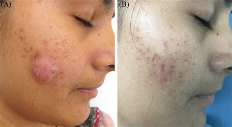 A Pretreatment Photograph Of Cystic Acne In A Young Female Patient B