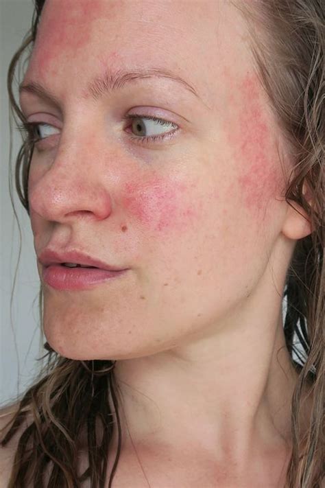 How To Treat Red Spots On Skin What Causes Red Bumps On Body