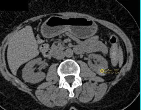 High Density Renal Cyst With Multiple Phases And Displays Kidney Case