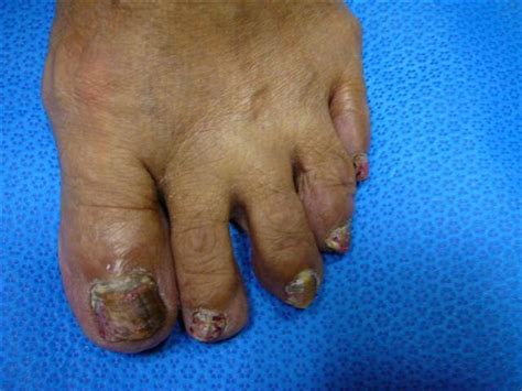 Toenail Fungus Advanced Foot And Ankle Center Of San Diego