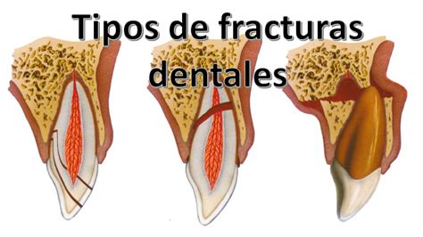 Tipos De Fracturas Dentales