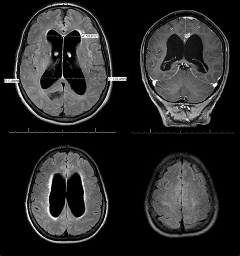 Neuroimaging In Nph A Axial Flair Mri Scan Showing A Significant