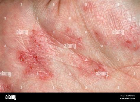 Close Up Of Mild Pompholyx A Form Of Eczema On The Palm Of The Hand A