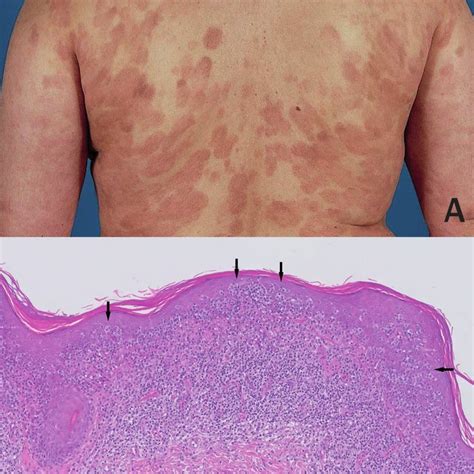Patch Stage Mycosis Fungoides A Erythematous Sharply Demarcated