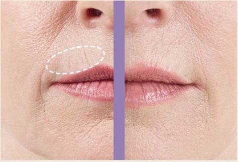 Triple Smooth Upper Lip Wrinkle Creamdecorinyltripeptide 1 Matrixyl