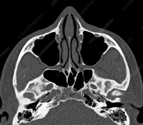 Normal sinuses, CT scan - Stock Image C029/4630 - Science Photo Library