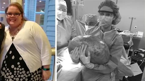 Alabama Woman Has 50 Pound Ovarian Cyst Removed Abc7 Chicago