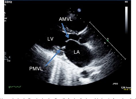 Figure 1 From Echocardiography In Mitral Stenosis Semantic Scholar