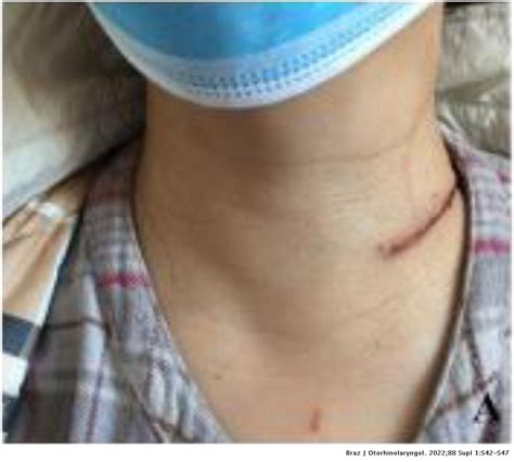 Application Of Lateral Supraclavicular Incision In Unilateral Thyroid