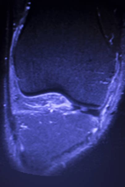 Meniscus Medial Obr Zky Stock Fotografie A Sn Mky Meniscus Medial