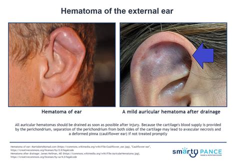 Hematoma Of The External Ear Smarty Pance