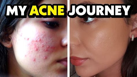 How I Cured My Acne With A Magic Pill💊 Hormonal Acne Natural