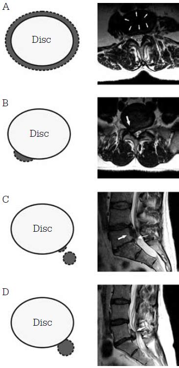 Lumbar Spine Mri Bulging Disc