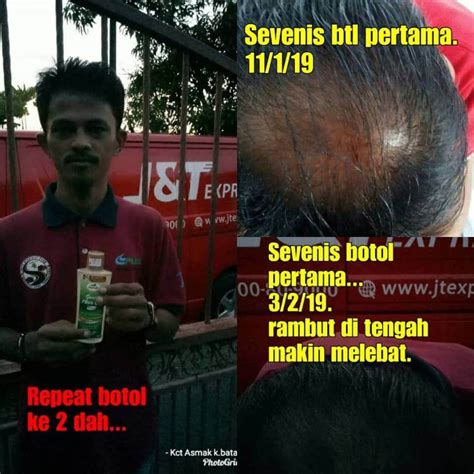 Diharapkan dengan cara mengatasi keguguran rambut semasa kehamilan, kehilangan boleh dikurangkan walaupun tidak dapat diselesaikan secara total. Cara Mudah Rawat Rambut Gugur Dengan Asmak Hair Care