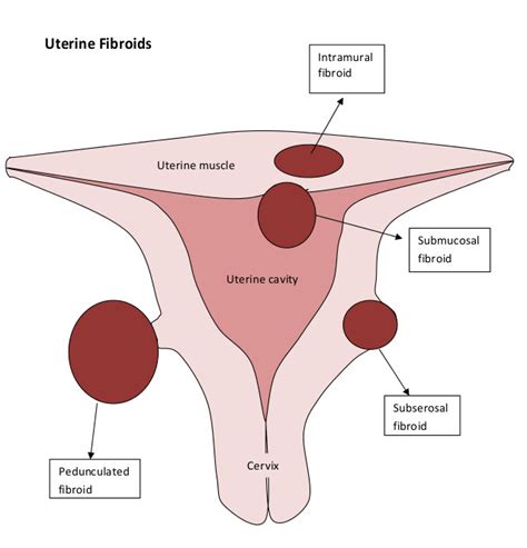 This page introduces the uterus as part of the internal female reproductive tract development. cervix - DriverLayer Search Engine
