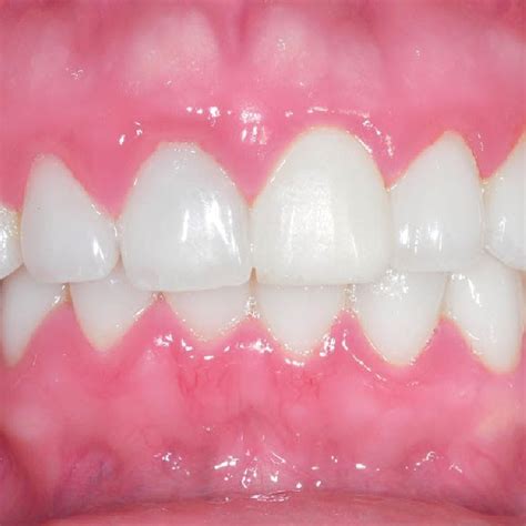 Healthy Lower Gum Line