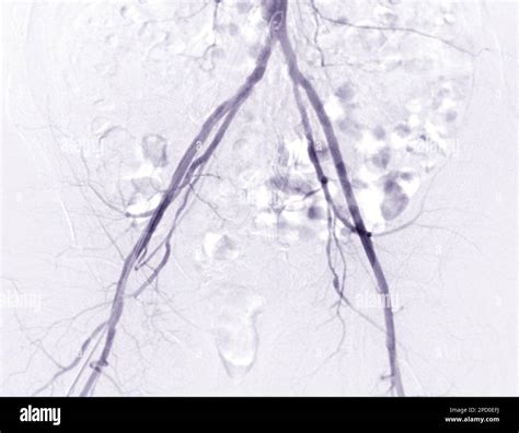Femoral Artery Angiogram Or Angiography Stock Photo Alamy