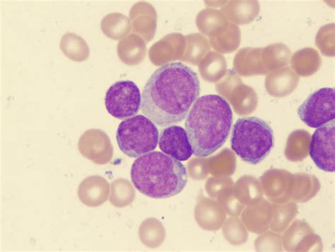 Acute Myelogenous Leukemia Cells Credit Univ Of Virginia
